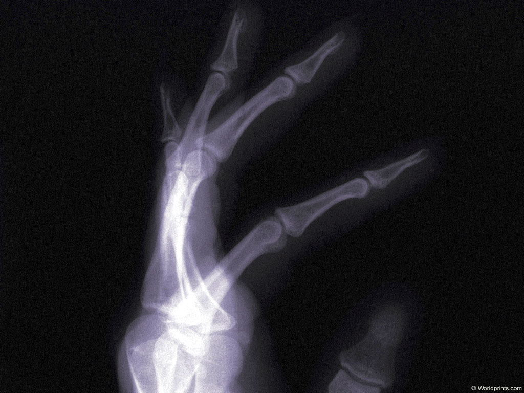 METACA1