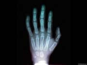 Xray_h100